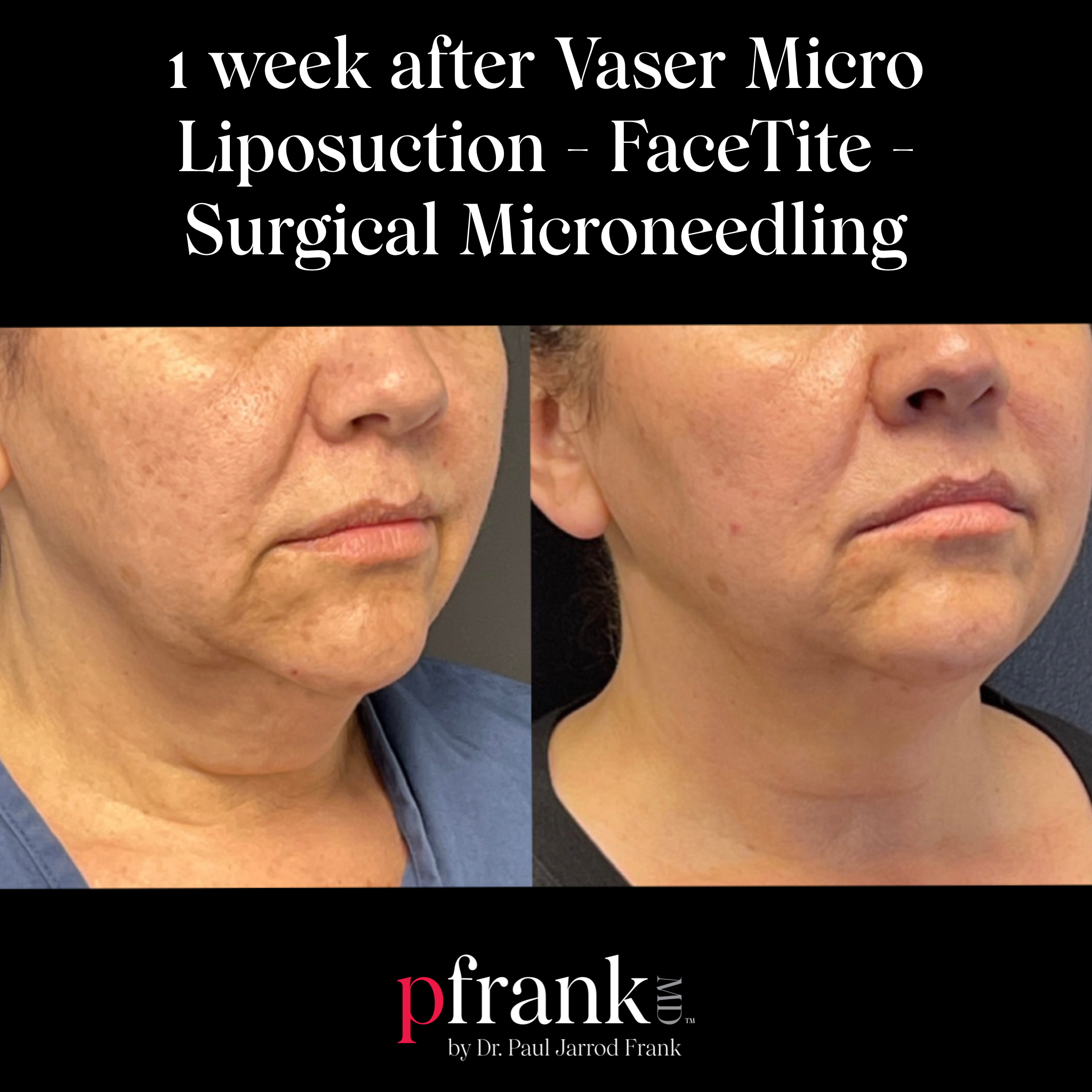 Vaser Micro Liposuction Facetite Surgical Microneedling Before and After Results