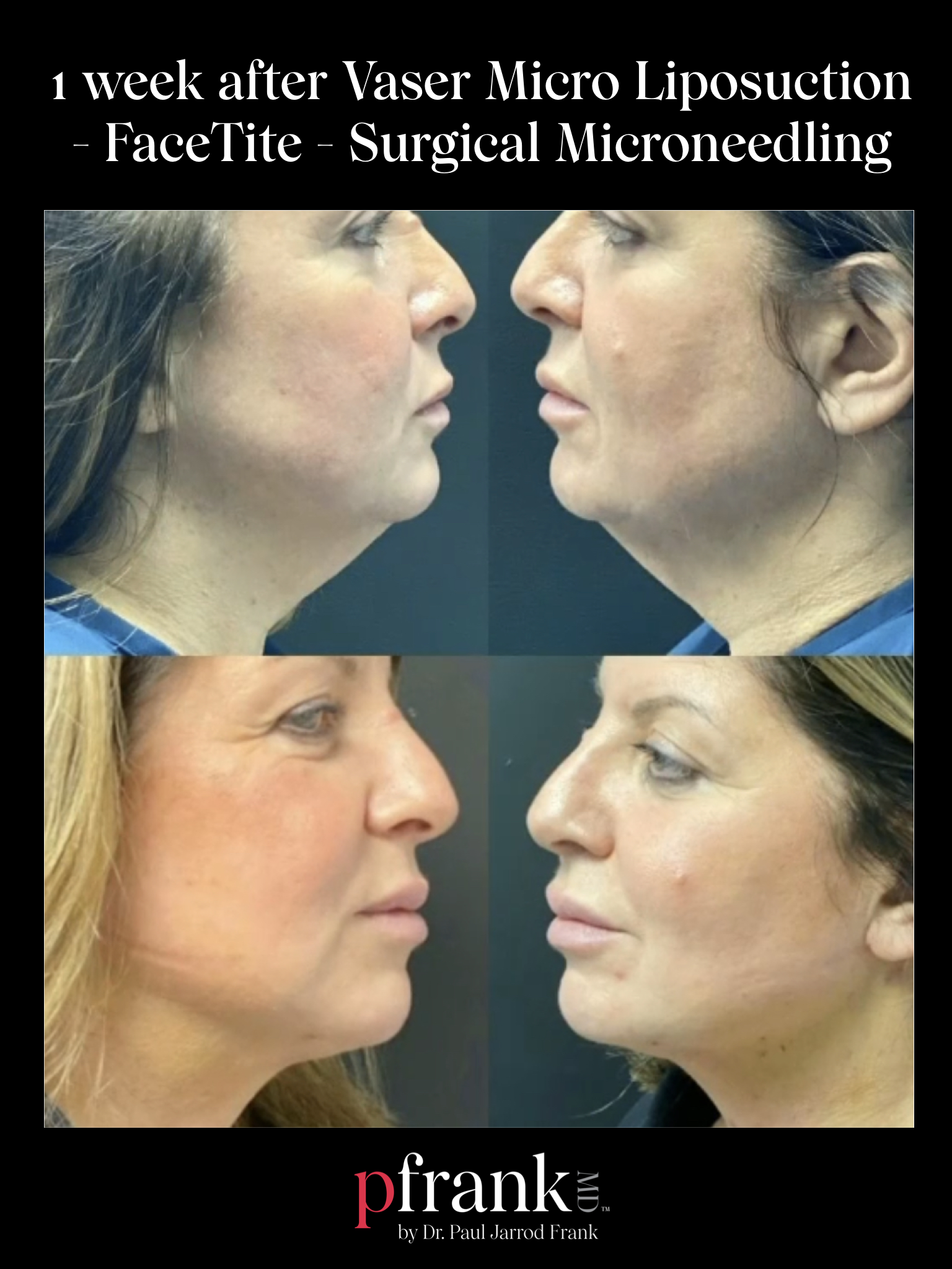 Vaser Micro Liposuction Facetite Surgical Microneedling Before and After Results