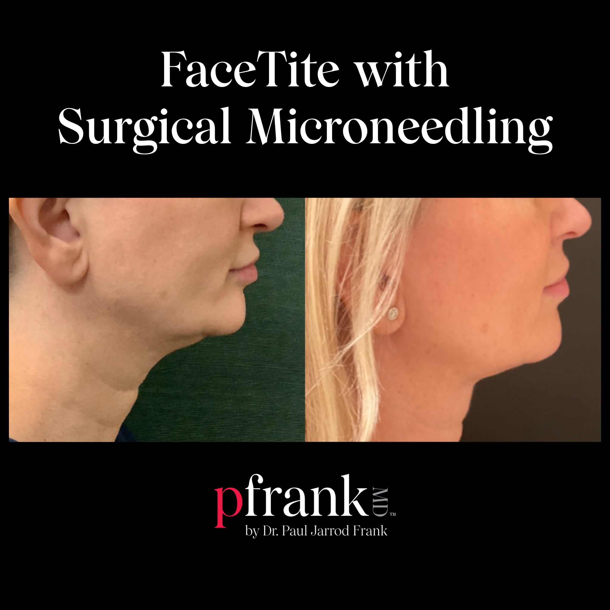 Facetite with Surgical Microneedling Before and After Results