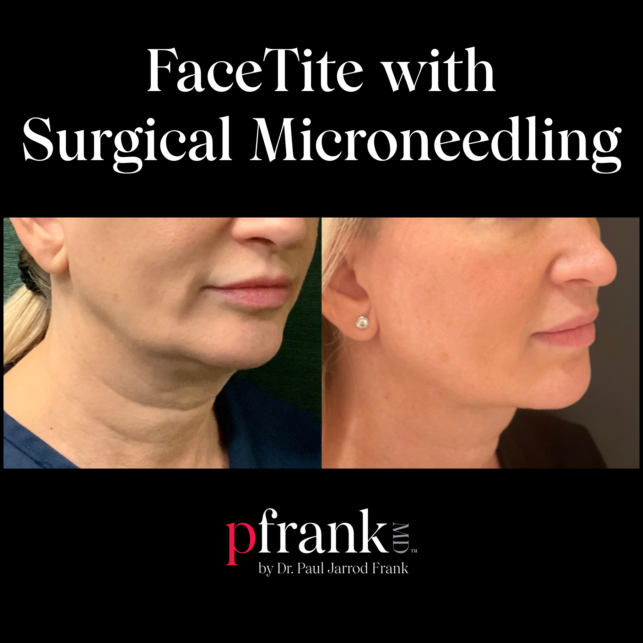 Facetite with Surgical Microneedling Before and After Results