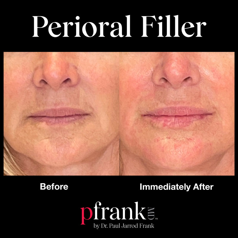 filler for the perioral area around the mouth - before and after