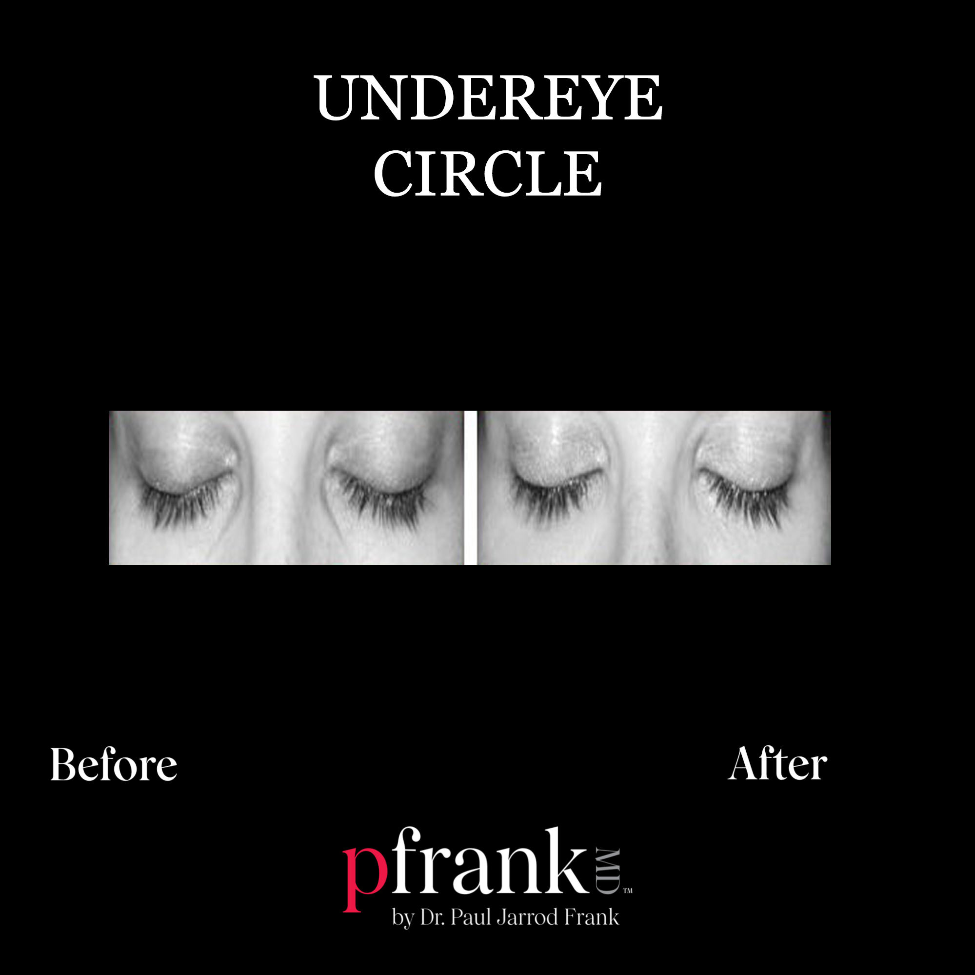Dark Eye Circles Before and After photo by Dr. Paul Jarrod Frank of PFRANKMD in New York City, NY