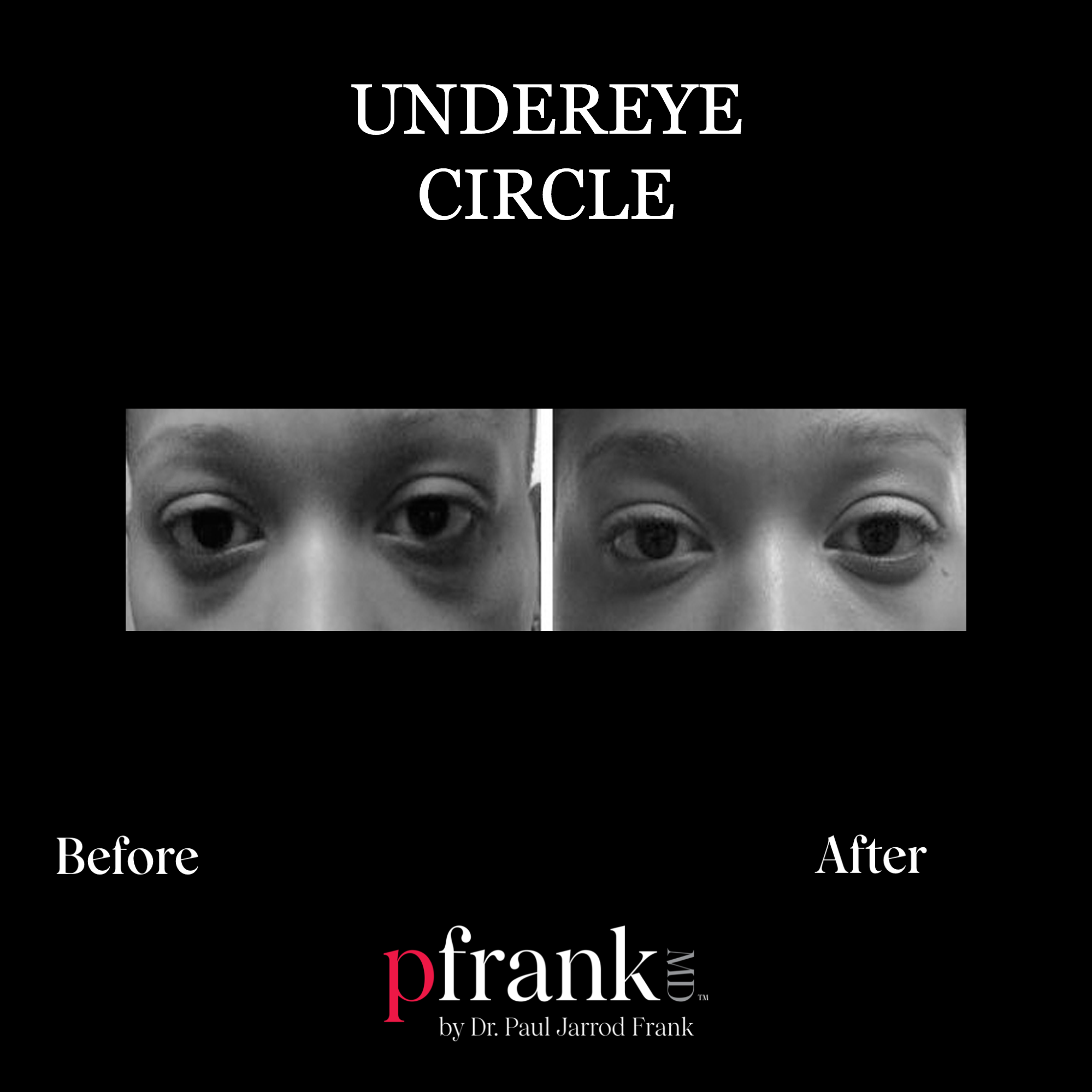 Dark Eye Circles PFRANKMD by Dr. Paul Jarrod Frank